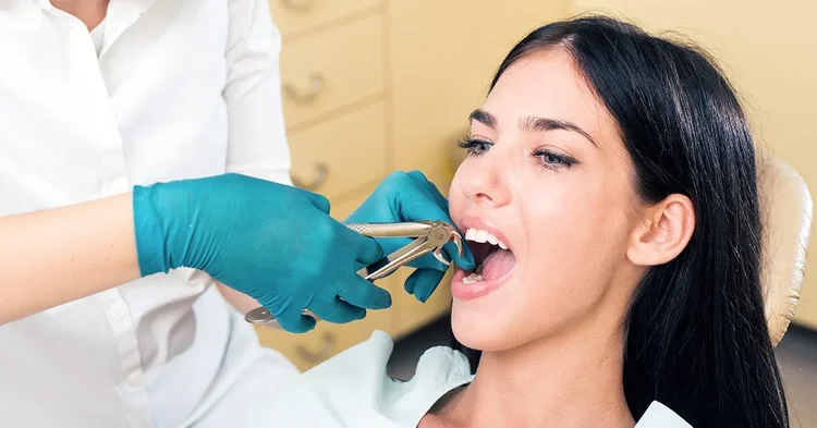 A picture of a dentist extracting a half knocked tooth