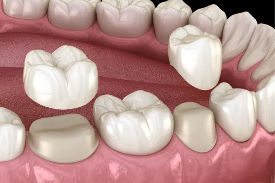 dental crown surrey